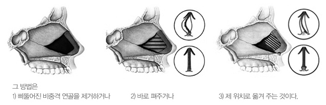 휜 코, 비중격까지 함께 봐야 하는 이유 설명 이미지
