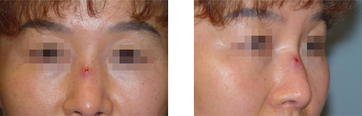 줄기세포 코성형은 어떤 경우에 할까?