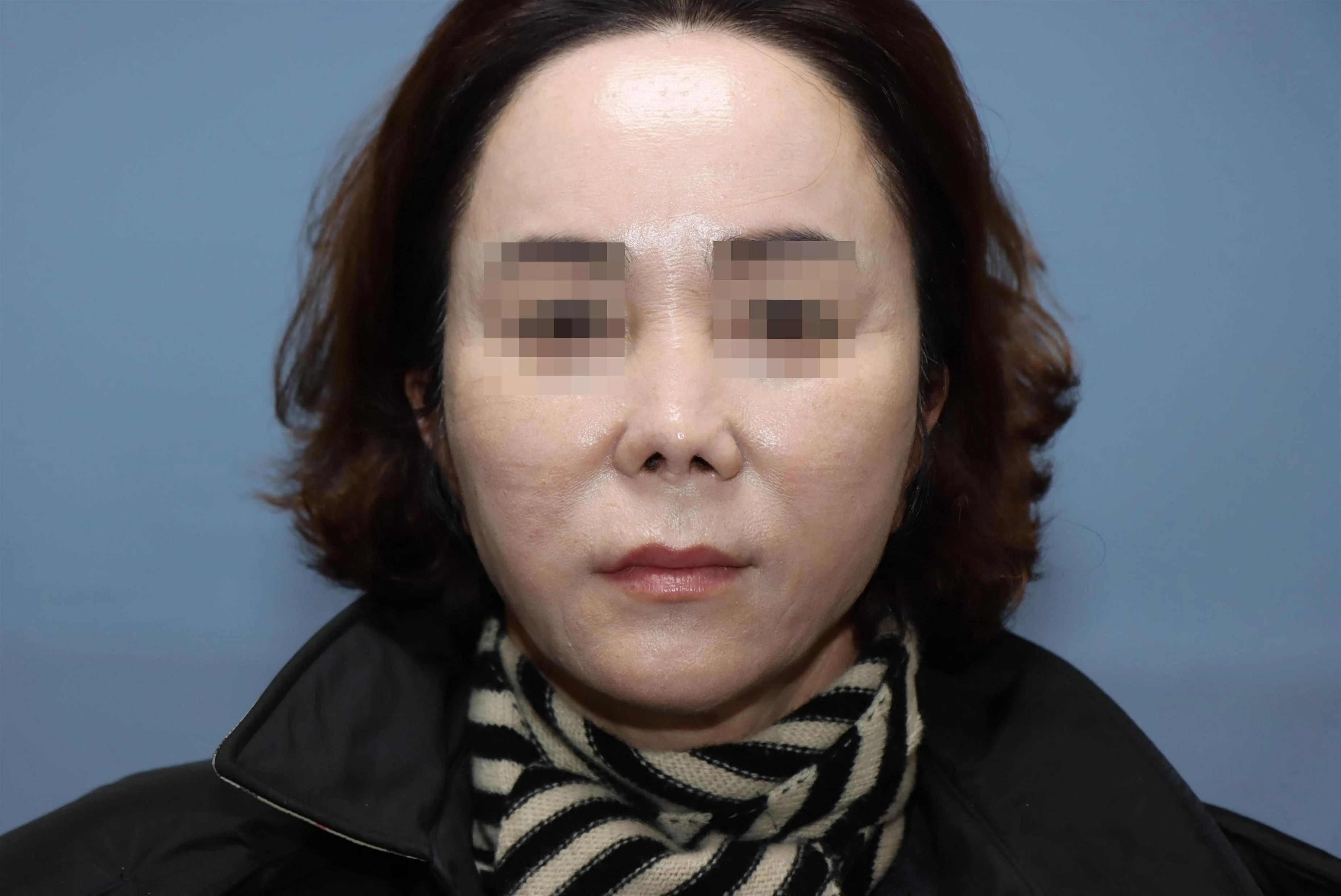 줄기세포 코성형 재건 수술 후 10개월 비교 사진 2